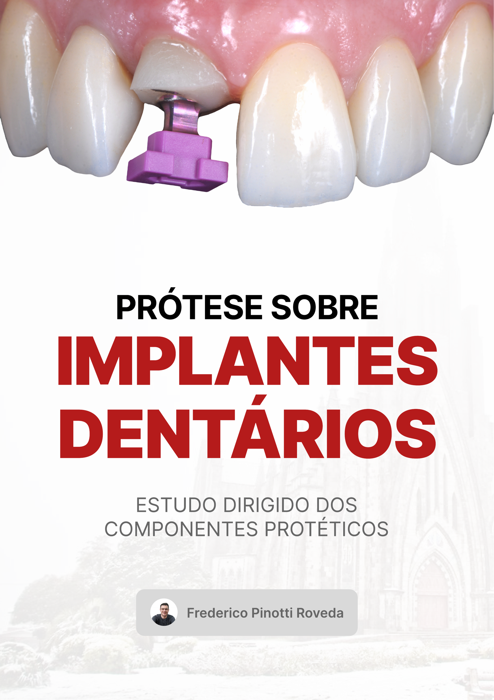 Prótese sobre Implante