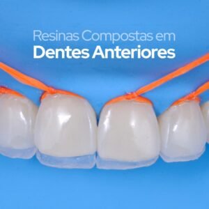 Imersão - Resinas Compostas em Dentes Anteriores - Joinville (05-06 Março)